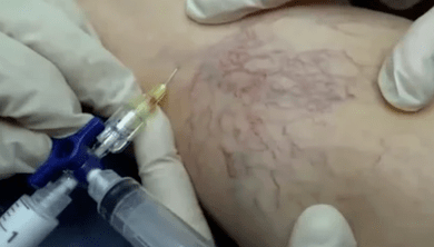 skleroteraapia veenilaiendite korral