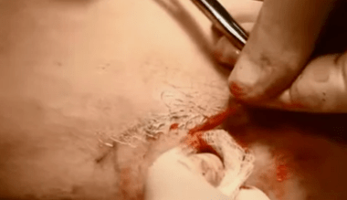 veenilaiendite eemaldamise operatsioonide tüübid